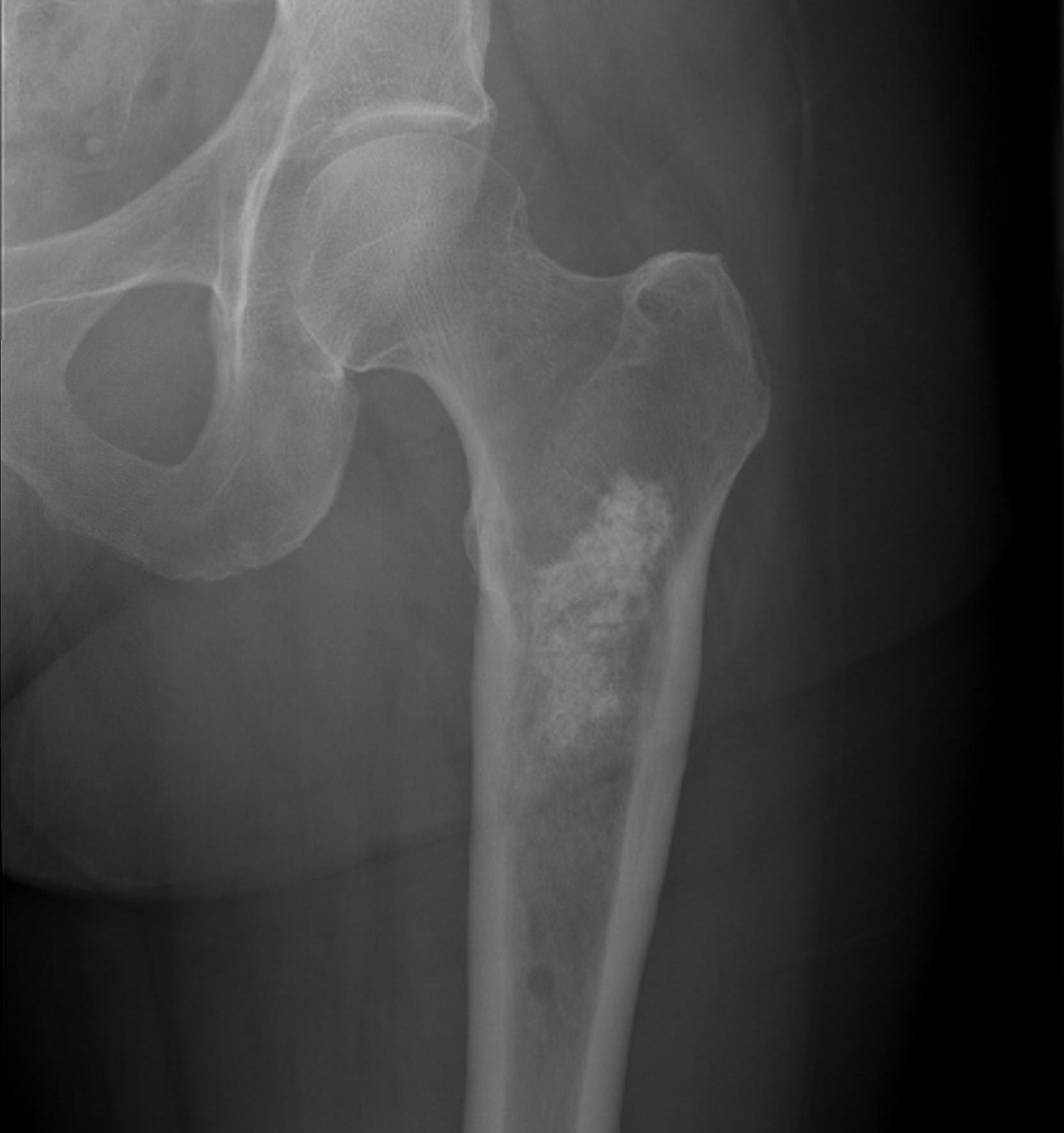 Chondrosarcoma Proximal Femur Xray0001